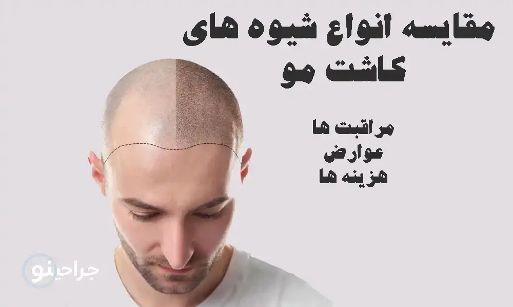 انواع روش‌های کاشت مو | مقایسه FUT، FUE، DHI و روش‌های پیشرفته